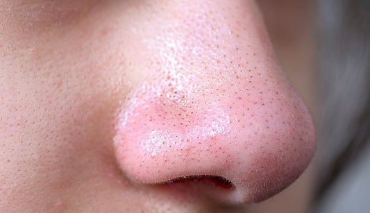 How do I get rid of my blackhead?