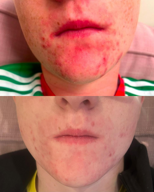Clear & Calming LED Mask - Before & After