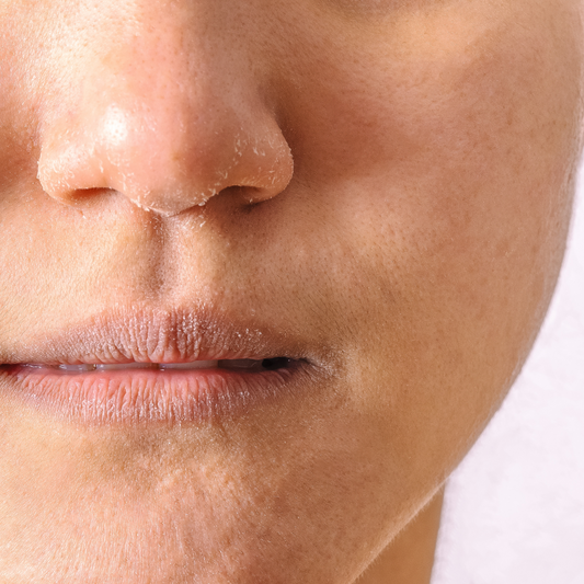 Get To Know Your Skin : Dry