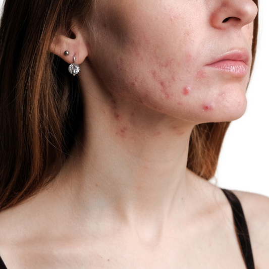 Get To Know Your Skin : Acne