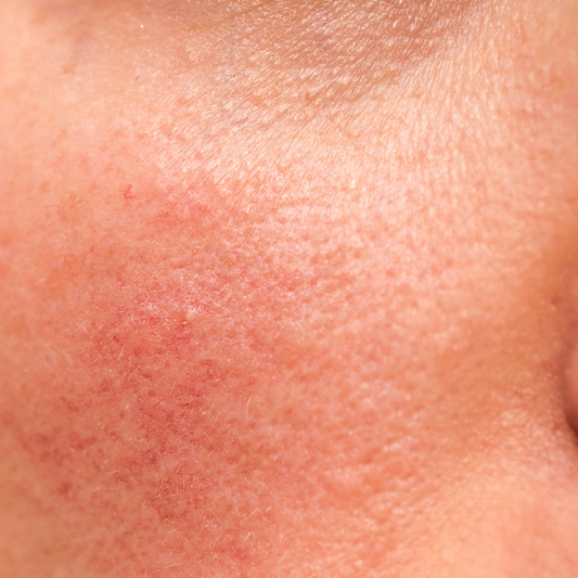Get To Know Your Skin: Rosacea