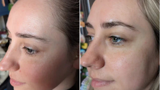 I ‘sanded’ my face in the name of beauty — and I'd happily do it again