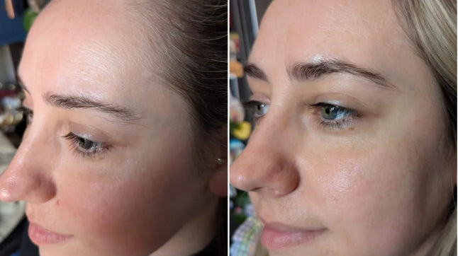 Microdermabrasion Kit